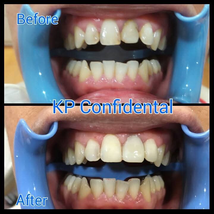 Before and after dental treatment