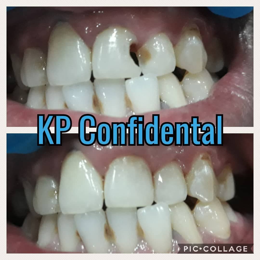 Before and after tooth restoration