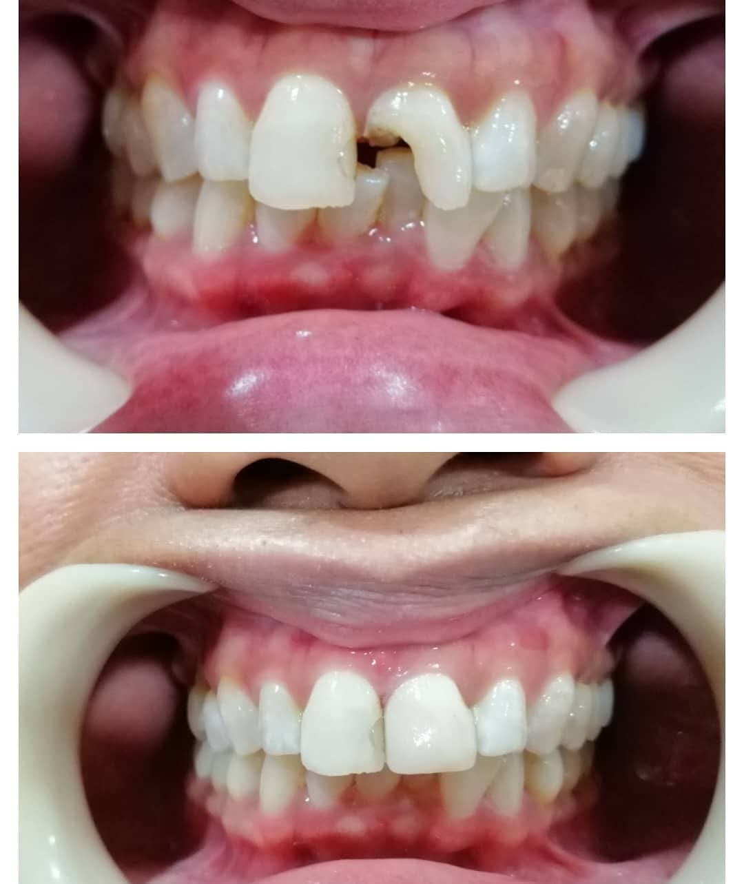 Before and after broken teeth rebuilt