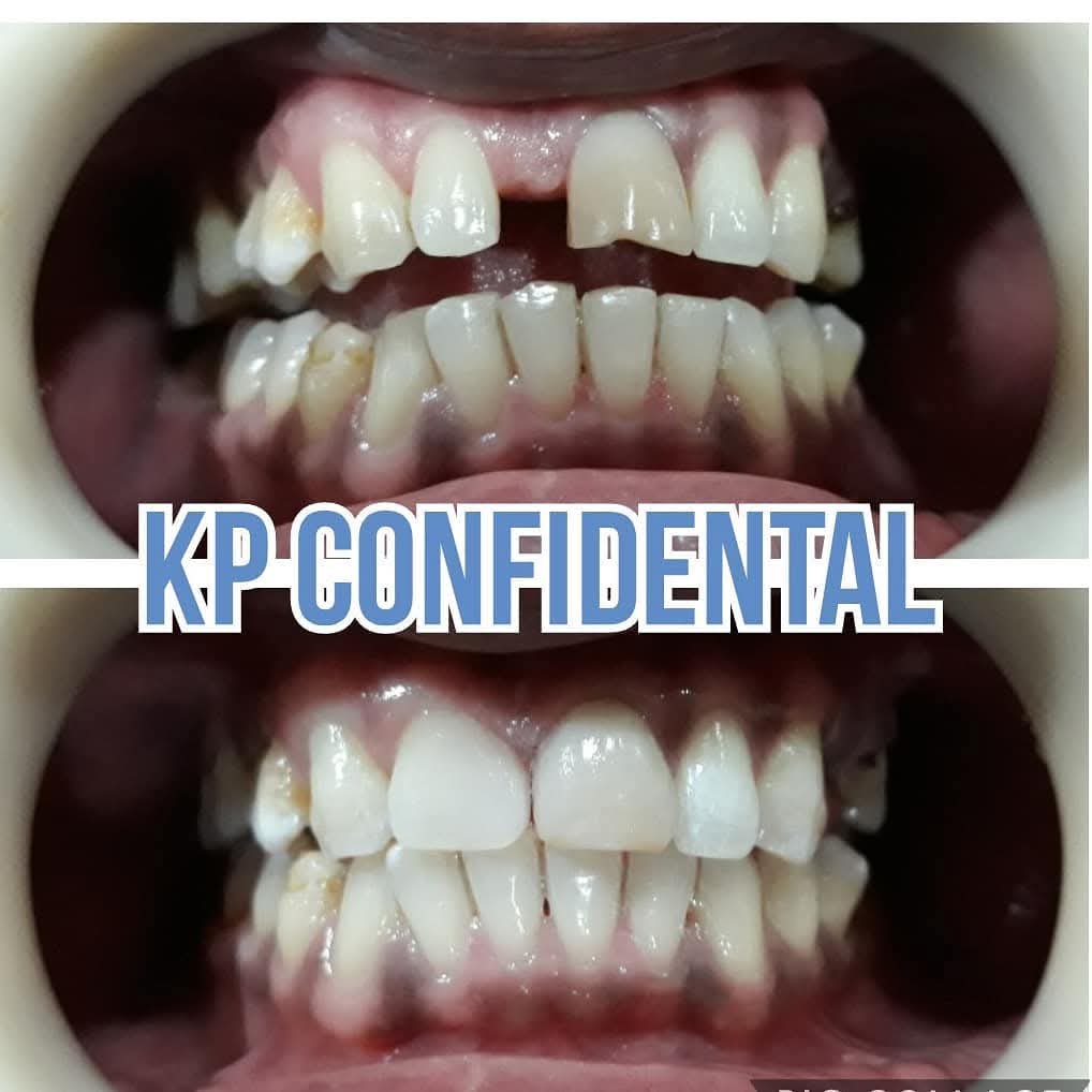 Before and after dental treatment