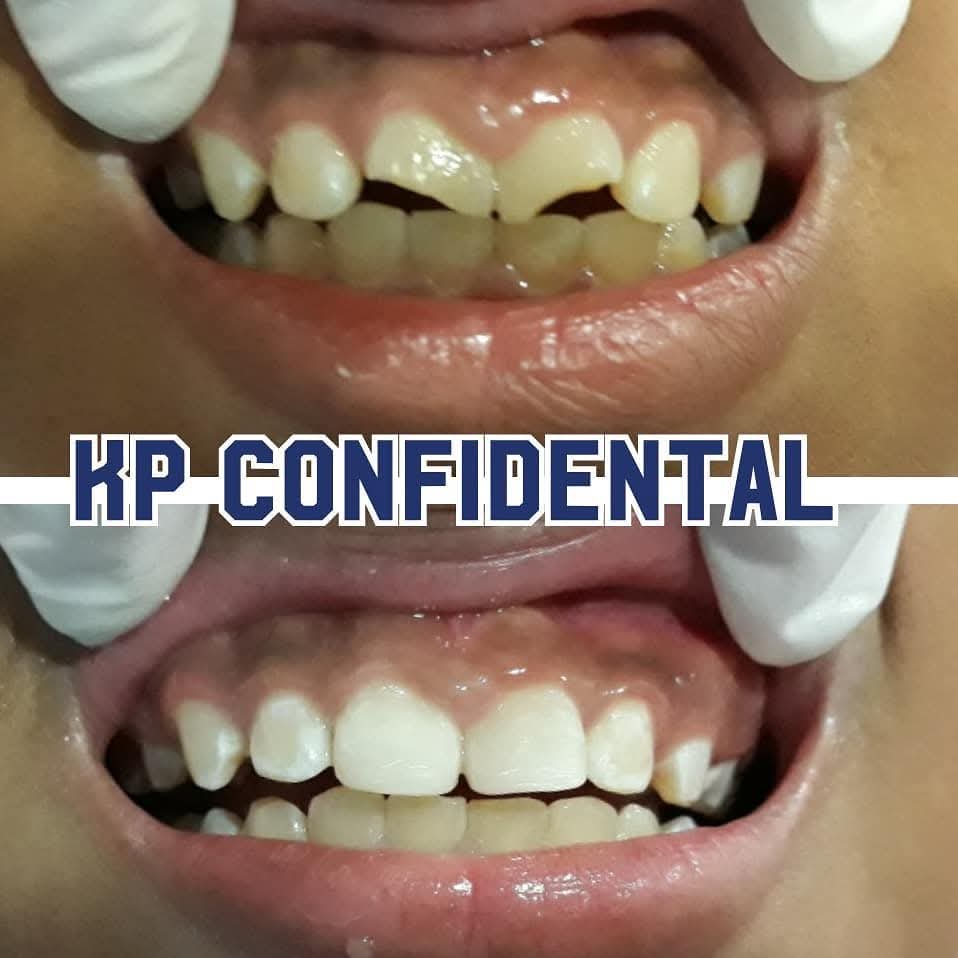 Before and after tooth reshaping